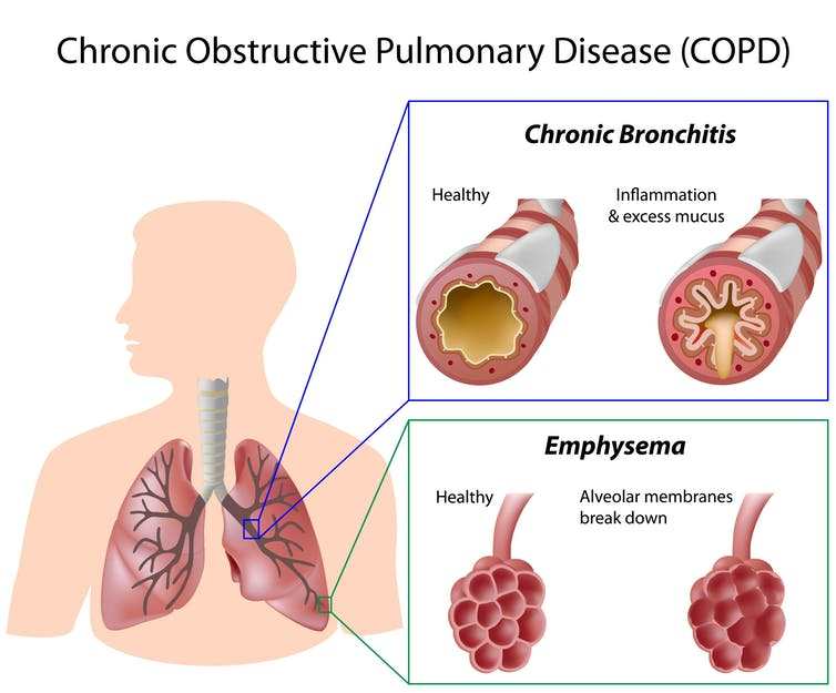 COPD Chronic Obstructive Pulmonary Disease