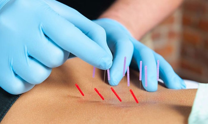 Dry Needling